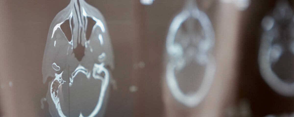 Understanding a Traumatic Brain Injury Claim in California