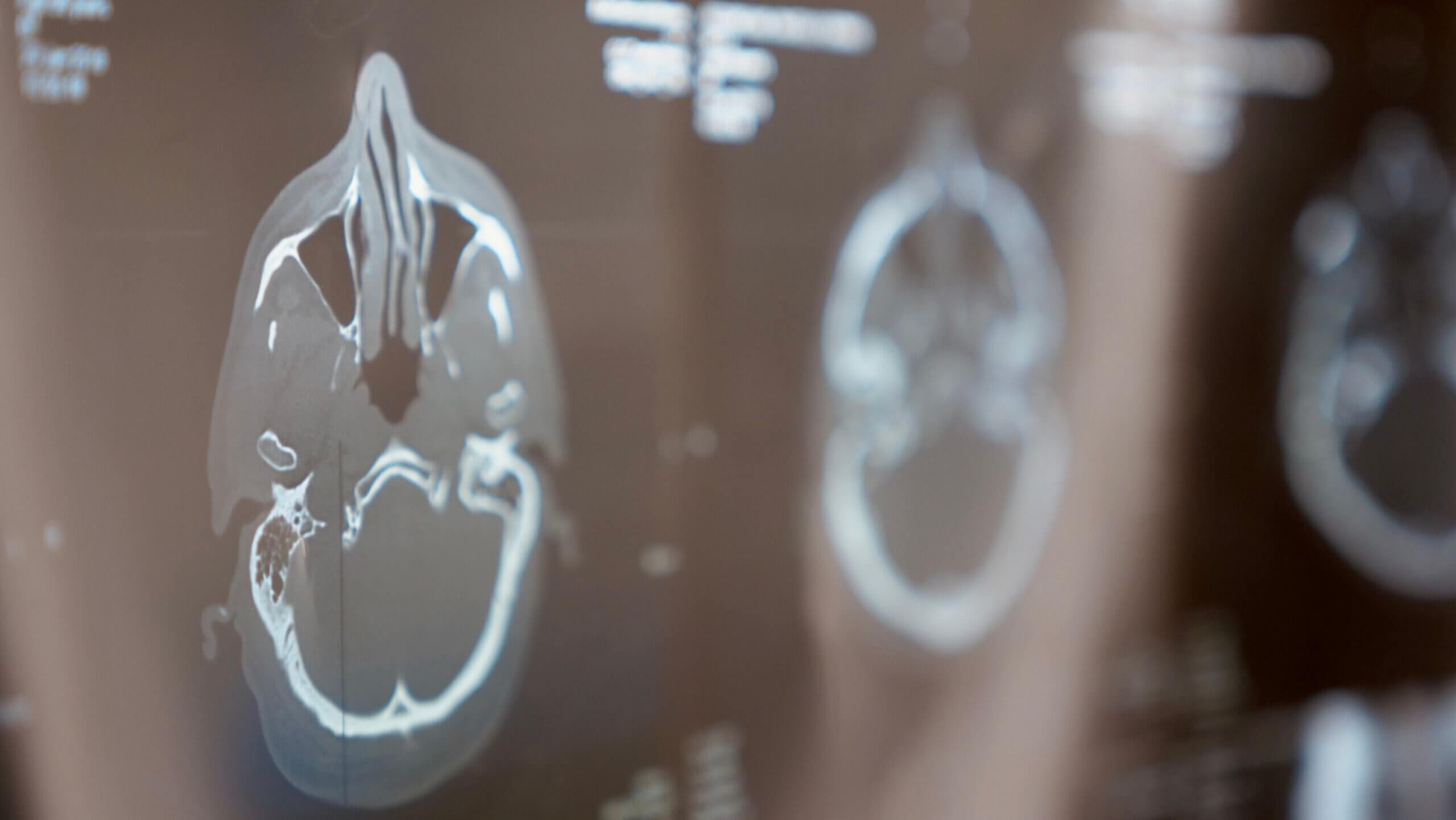 加州创伤性脑损伤索赔指南- Hillstone Law 意外伤害律师