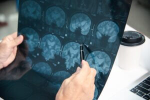 Brain Injuries