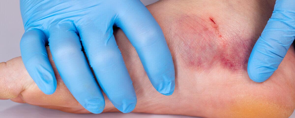 Dog Bite Injury Lawyer in California: Protecting Victims of Animal Attacks