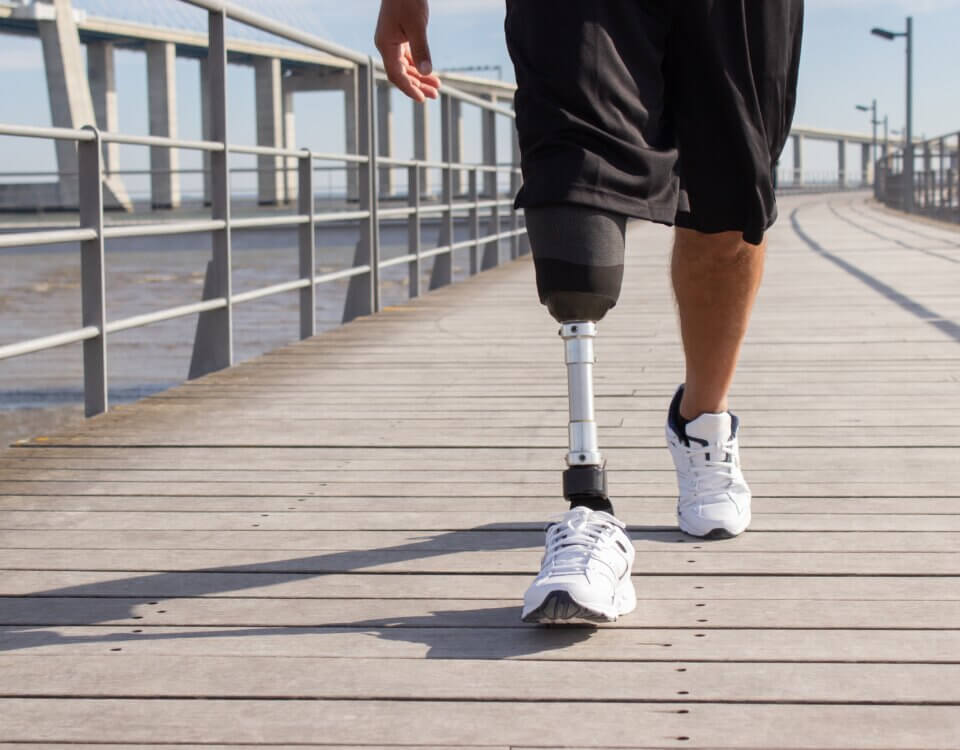 Amputation Injury Lawyer in California: Fighting for Victims of Catastrophic Injuries