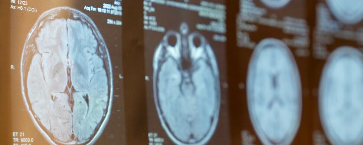 Top 10 Most Common Brain Injuries After an Accident