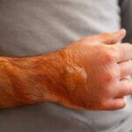 How to Avoid Severe Burns in Los Angeles Workplaces