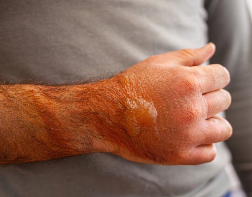 How to Avoid Severe Burns in Los Angeles Workplaces