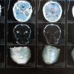 Common Signs and Symptoms of Traumatic Brain Injury (TBI)