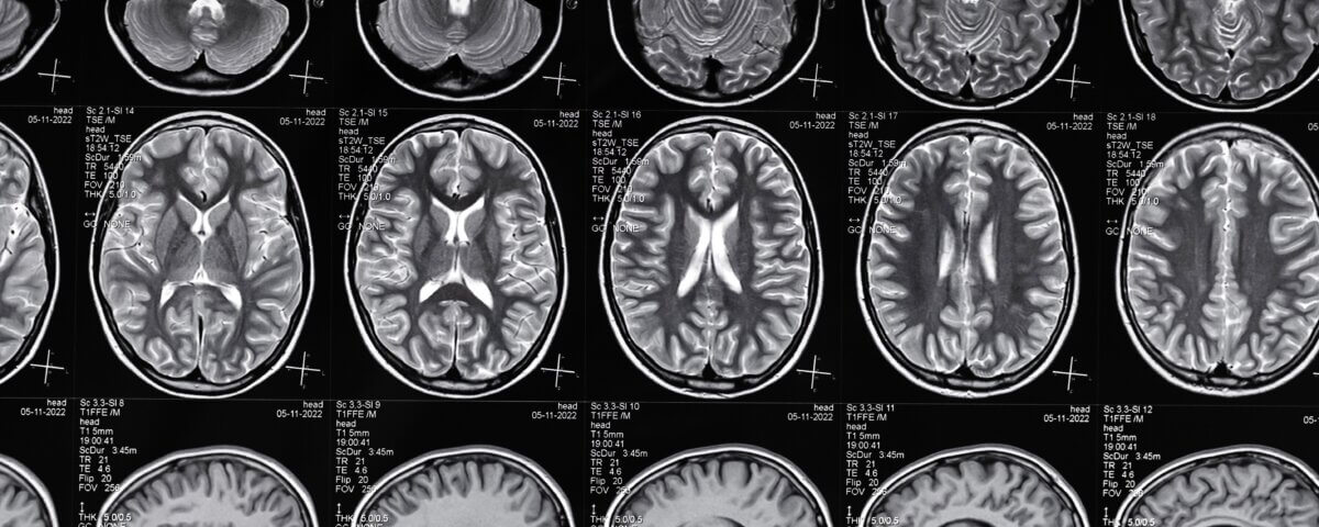 Types of Accidents That Lead to Traumatic Brain Injury