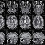 Types of Accidents That Lead to Traumatic Brain Injury