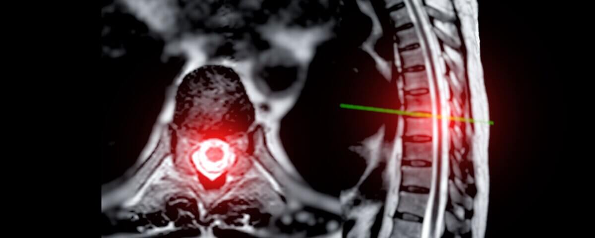 The Long-Term Emotional Cost of Spinal Cord Injuries in Sacramento in 2025