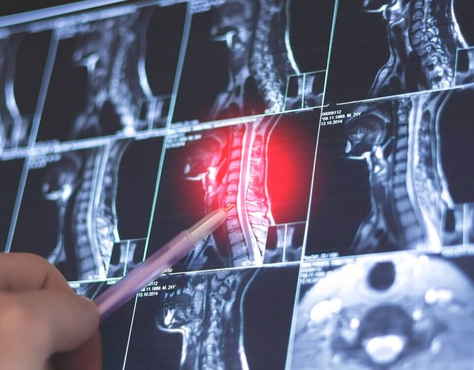 How Spinal Injuries Occur: Common Accident Types and Legal Perspectives