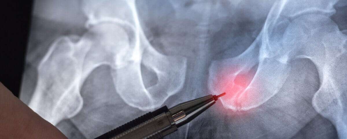 Car Accidents and Hidden Pelvic Injuries: What Victims Should Know
