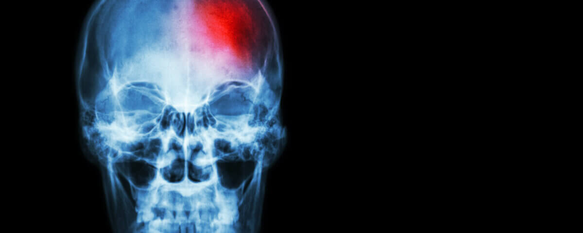 Can You File a Lawsuit for a Traumatic Brain Injury