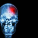 Can You File a Lawsuit for a Traumatic Brain Injury