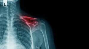 Shoulder Injury Lawyers